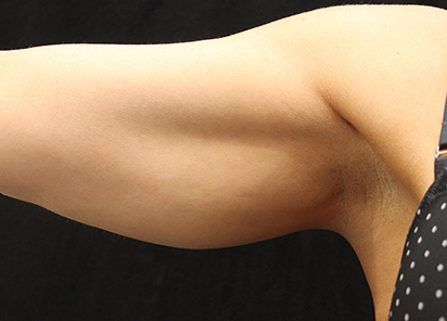Exilis 360 en Brazos - Después